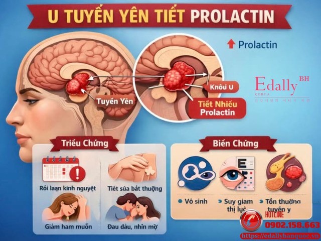Đừng bỏ qua những dấu hiệu nhỏ của u tuyến yên tiết Prolactin