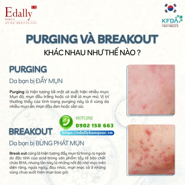 Sự khác nhau giữa đẩy mụn (Purging) và bùng mụn (Break out) do dùng BHA như thế nào?