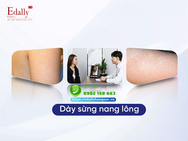 Dày sừng nang lông - Nguyên nhân, triệu chứng và cách điều trị hiệu quả