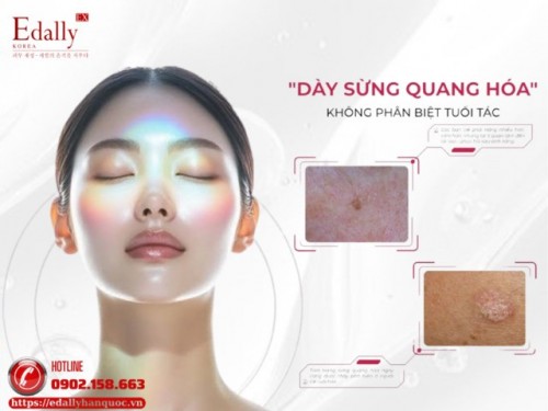 Dày Sừng Quang Hóa: Nguyên Nhân, Triệu Chứng Và Cách Xử Lý