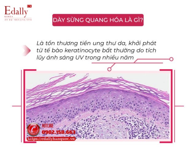 Da bị dày sừng quang hóa là như thế nào?