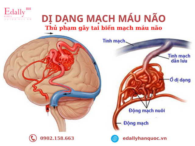 Dị dạng mạch máu não là nguyên nhân gây tai biến mạch máu não