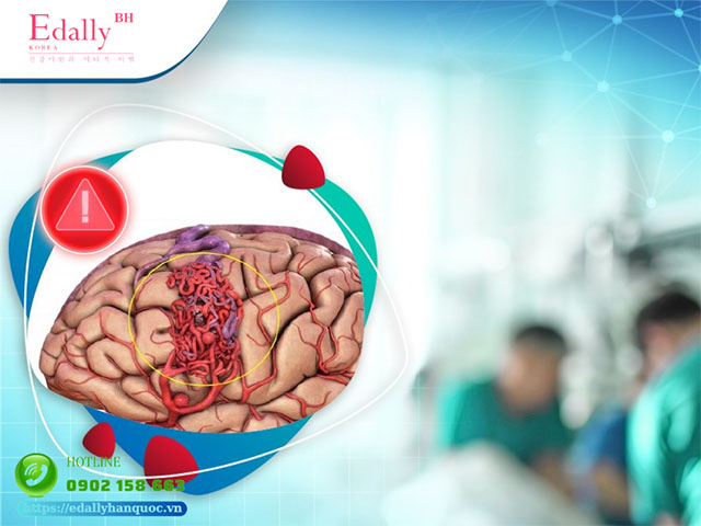 Dị dạng mạch máu não thường gây ra những cơn đau đầu kéo dài