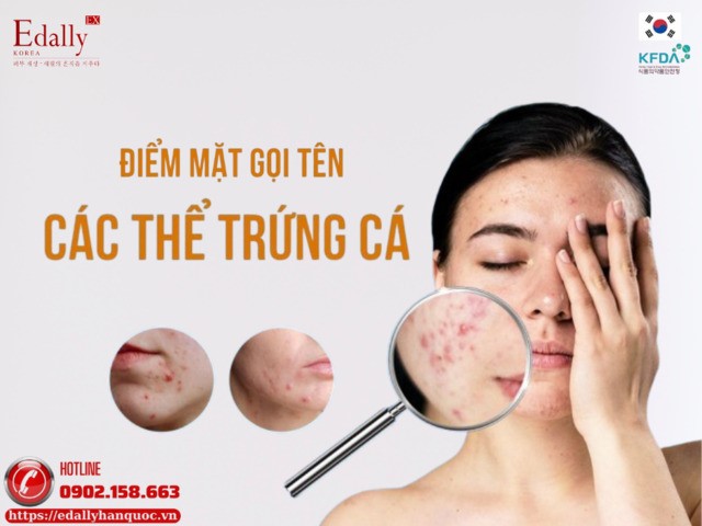 Điểm mặt gọi tên các thể mụn trứnɡ ᴄá