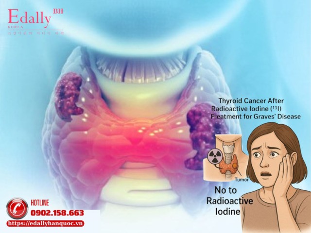 Điều Trị Iod Phóng Xạ Cho Bệnh Nhân Basedow Có Làm Tăng Nguy Cơ Bị Ung Thư Tuyến Giáp Không?