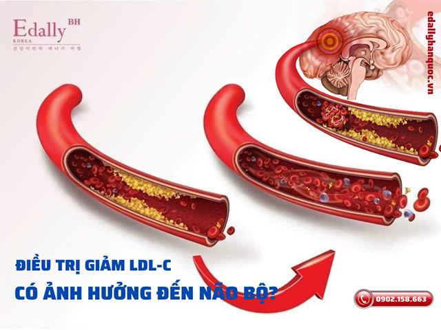 Điều trị giảm LDL-Cholesterol thấp có ảnh hưởng đến cấu trúc và chức năng não bộ không?