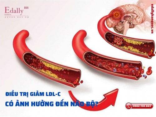 Điều Trị Giảm LDL-Cholesterol Thấp Có Ảnh Hưởng Đến Cấu Trúc Và Chức Năng Não Bộ Không?