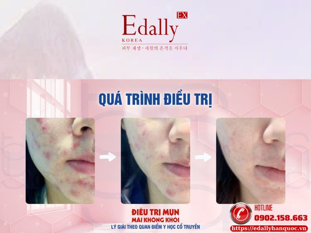 Điều trị mụn mãi không - Lý giải theo quan điểm của Y học cổ truyền (YHCT)