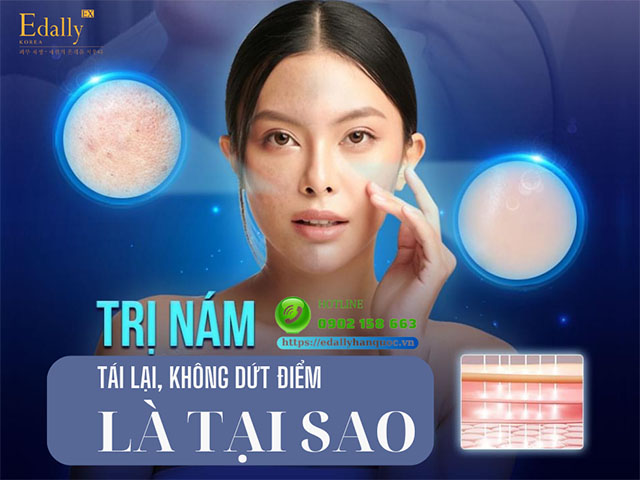 Lý do trị nám da bị tái lại, không dứt điểm là tại sao?