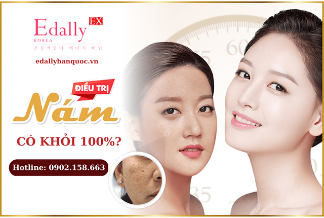 Điều trị nám da có khỏi dứt điểm không?