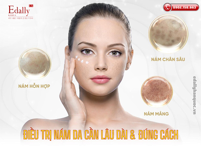 Điều trị nám da cần thời gian lâu dài và đúng cách