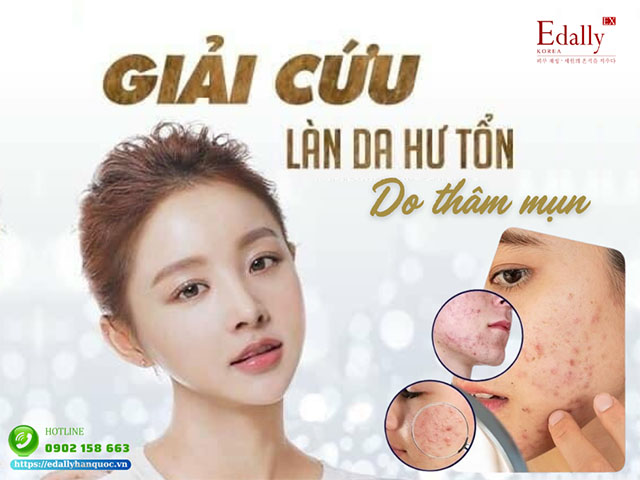 Điều trị thâm mụn đúng cách để giải quyết triệt để