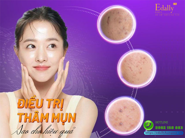 Điều trị da thâm mụn như thế nào cho hiệu quả?