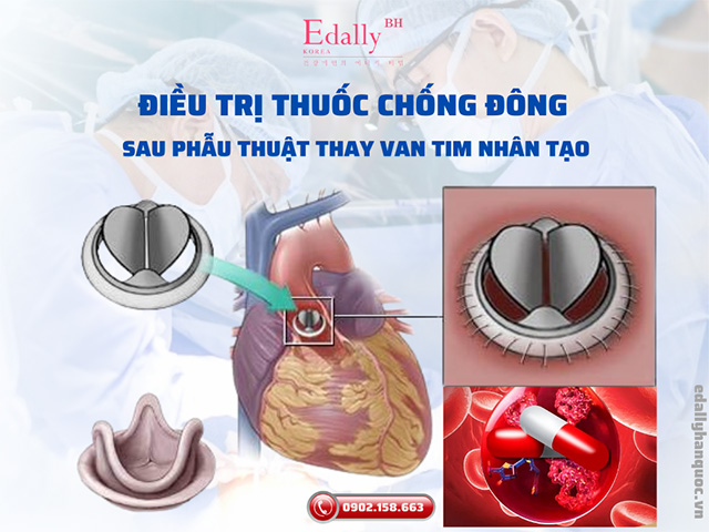 Tầm quan trọng của điều trị thuốc chống đông máu sau phẫu thuật thay van tim nhân tạo và cách thức áp dụng