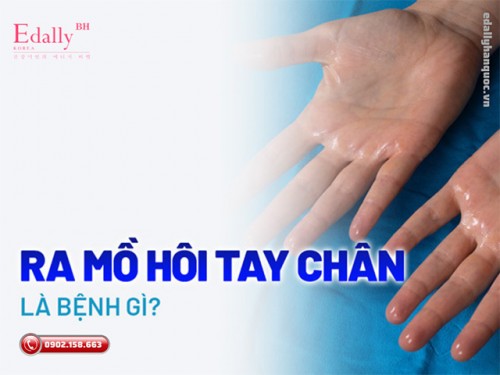 Ra Mồ Hôi Tay Chân Là Bệnh Gì Và Có Chữa Khỏi Hoàn Toàn Được Không?