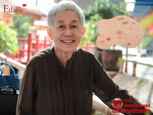 Đốm Nâu Trên Da Ở Người Lớn Tuổi (Senile Lentigo) - Những Điều Cần Biết