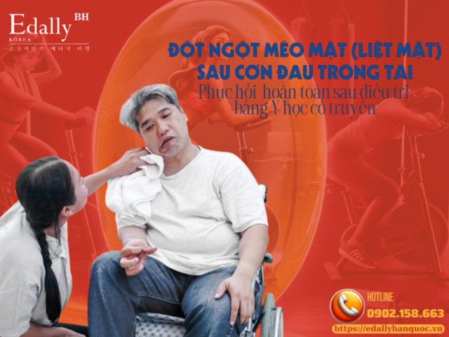 Đột Ngột Méo Mặt (Liệt Mặt) Ngoại Biên Sau Cơn Đau Sau Tai