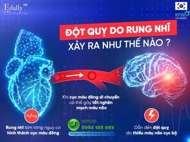 Đột quỵ do rung nhĩ xảy ra như thế nào?