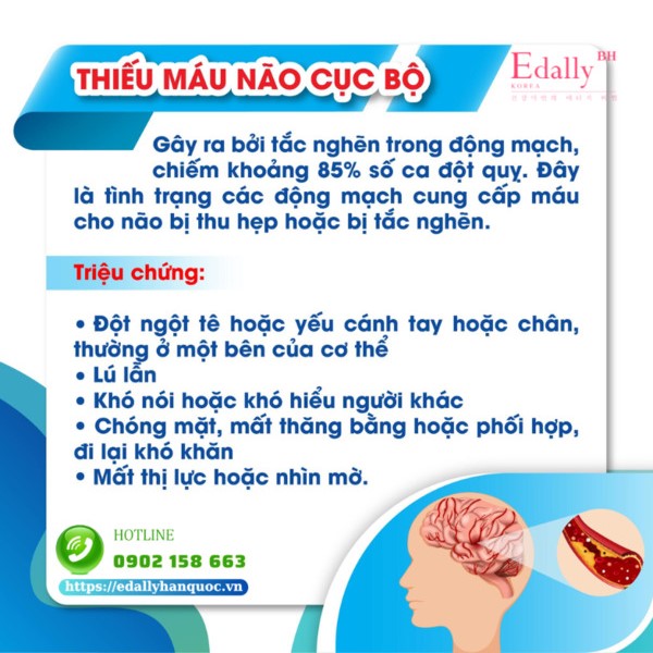 Đột quỵ do thiếu máu não cục bộ