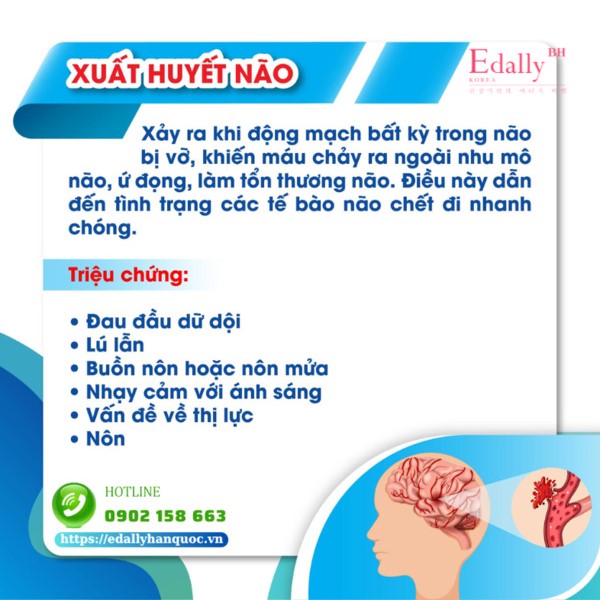 Đột quỵ do xuất huyết não