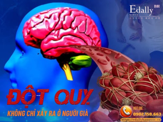 Đột quỵ không chỉ xảy ra ở người già