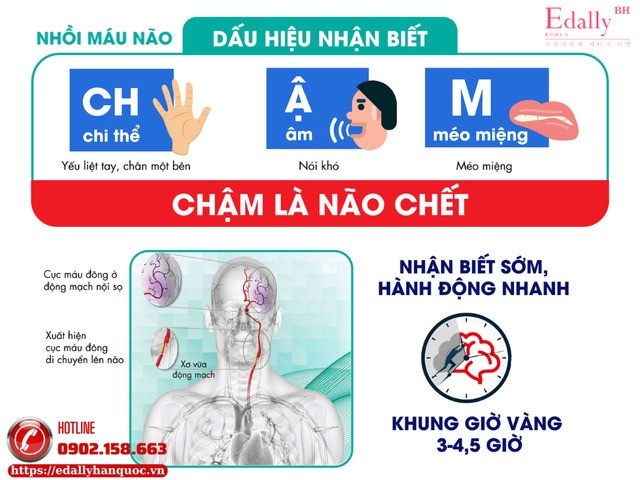Đột quỵ nhồi máu não - Chậm là chết não