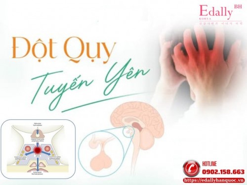 Đột Quỵ Tuyến Yên: Nguyên Nhân, Triệu Chứng Và Cách Chẩn Đoán, Điều Trị
