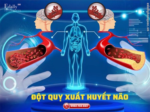 Đột Quỵ Xuất Huyết Não - Cách Nhận Diện Và Phòng Ngừa