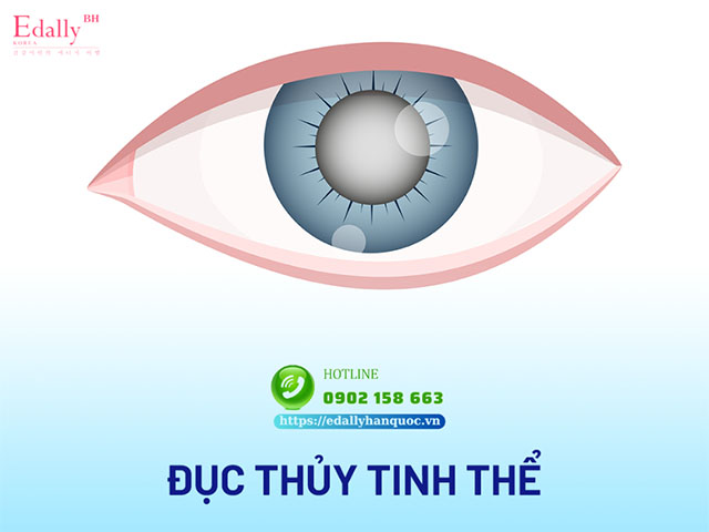 Đục thủy tinh thể do bệnh tiểu đường