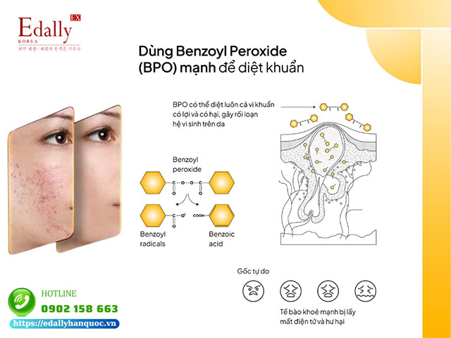 Dùng benzoyl peroxide (BPO) mạnh để diệt khuẩn, trị mụn có thể diệt luôn cả vi khuẩn có lợi và có hại, gây rối loạn hệ vi sinh trên da