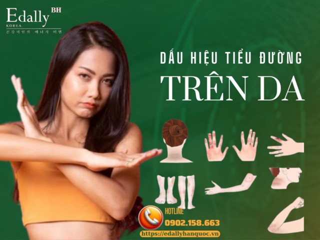 12 Dấu Hiệu Trên Da Của Bệnh Tiểu Đường