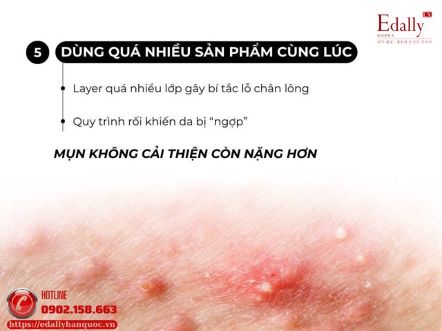 Sử dụng quá nhiều sản phẩm cùng lúckhi kết hợp sản phẩm trị mụn khiến mụn ngày càng tệ hơn