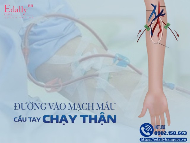 Đường vào mạch máu - cầu tay để chạy thận nhân tạo và những điều cần biết