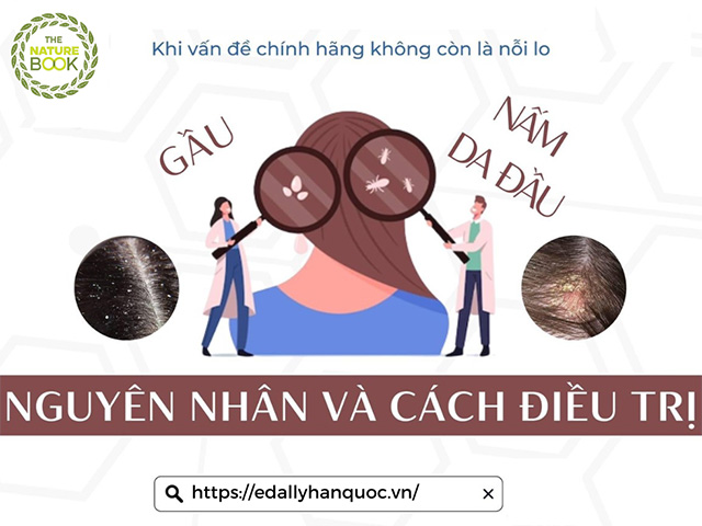 Gàu Và Nấm Da Đầu Là Gì? Cách Trị Gàu Và Nấm Da Đầu Tại Nhà?