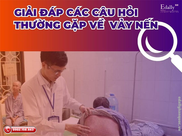 Giải đáp một số câu hỏi thường gặp về bệnh vảy nến