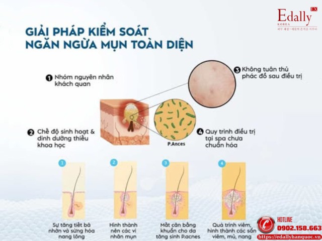 Giải pháp kiểm soát và ngăn ngừa mụn tái phát