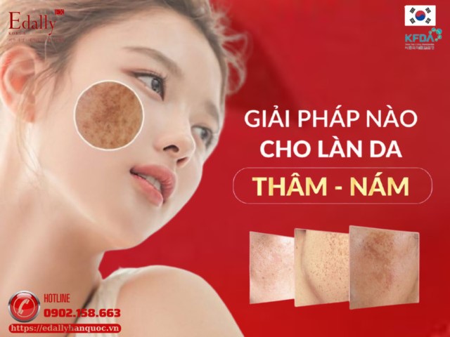 Giải pháp nào thay thế Hydroquinone (HQ) cho làn da thâm - nám?