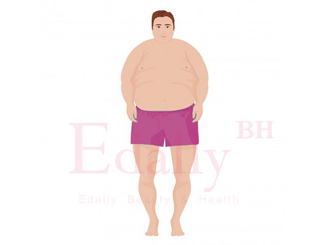 Hình thể người thừa mỡ trên toàn bộ cơ thể