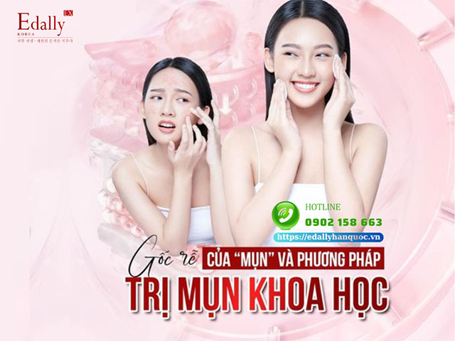 Gốc rễ của mụn và phương pháp trị mụn khoa học