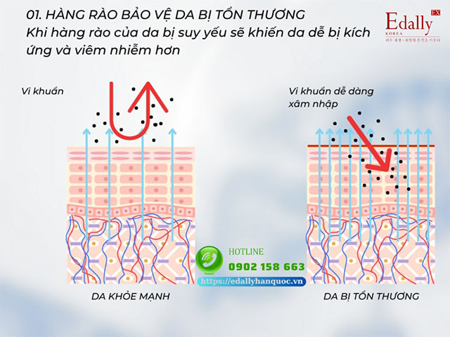 Hàng rào bảo vệ da bị tổn thương là thách thức trong điều trị nền da yếu