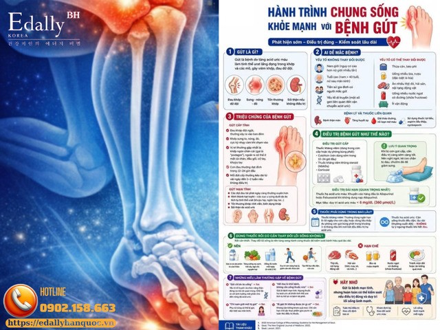 Hành trình chung sống khỏe mạnh với bệnh gút