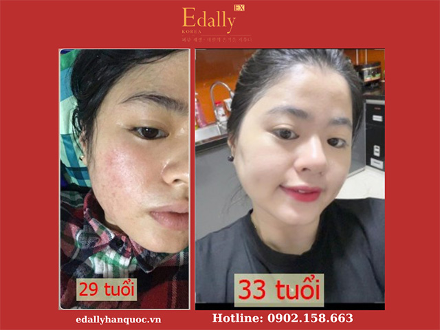 Nhan sắc trước và sau khi sử dụng & kinh doanh dụng Mỹ phẩm Edally EX Hàn Quốc của cô gái 9x xứ Huế