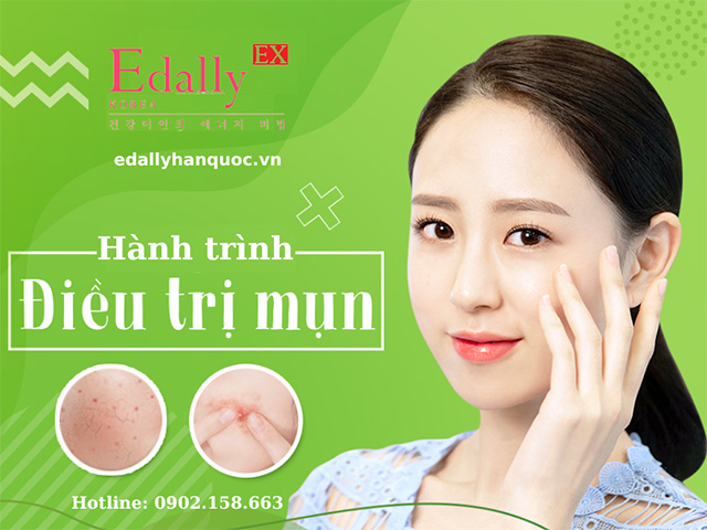 Hành trình trị mụn hiệu quả nhất tại nhà