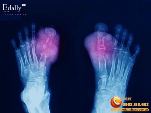 Hạt Tophi Là Gì Và Có Phải Ai Bị Gout Cũng Có?