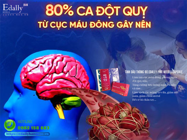 80% các ca đột quỵ do cục máu đông xuất hiện ở não gây ra