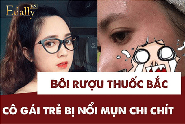 Hậu quả khi sử dụng rượu thuốc trị mụn tái tạo da của cô gái trẻ ở Nghệ An