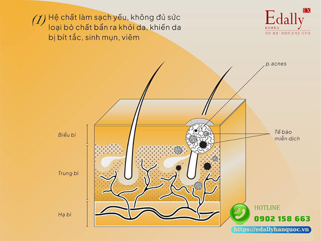 Làn da không đủ sạch sâulà vấn đềlàn da dầu mụn thường gặp ở bước làm sạch khiến mụn tái đi tái lại