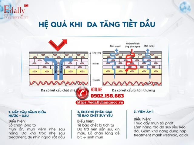 Hệ quả khi da tăng tiết dầu