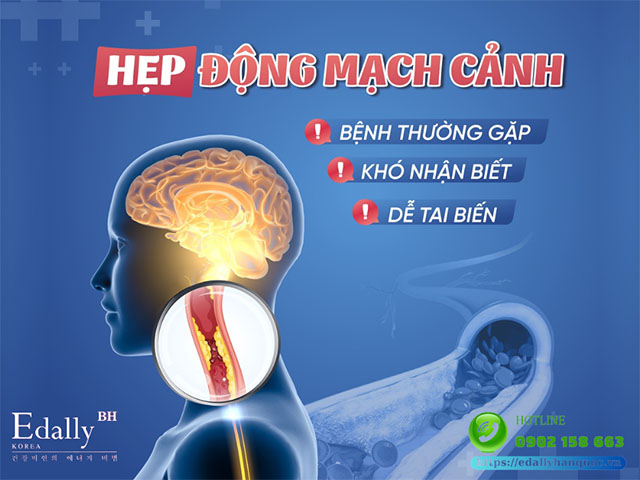 Hẹp động mạch cảnh - bệnh thường gặp, khó nhận biết, dễ tai biến