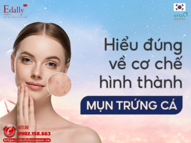 Hiểu đúng về cơ chế hình thành mụn trứng cá để điều trị hiệu quả